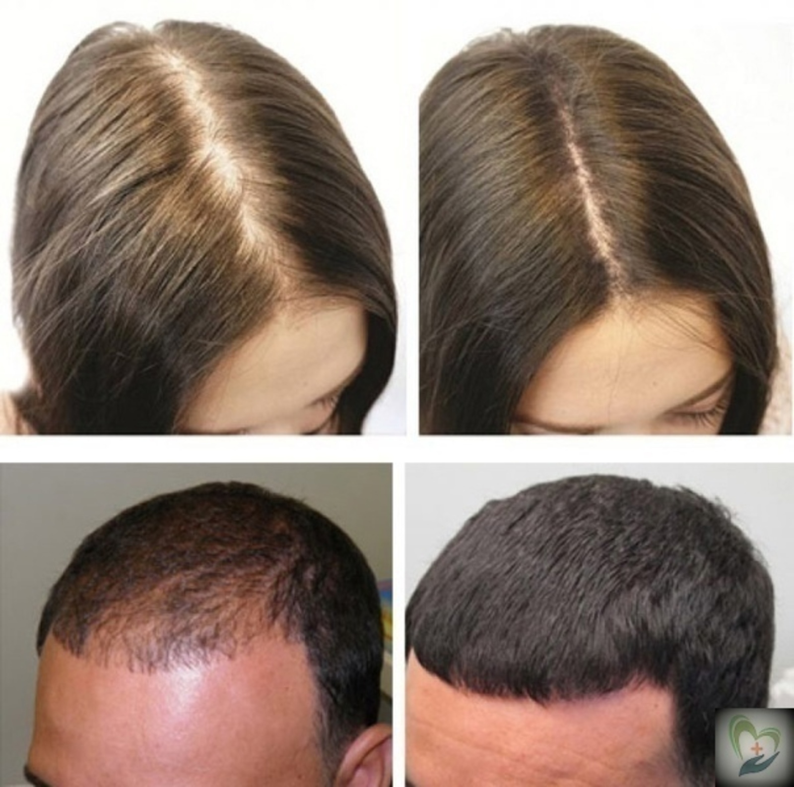 Сильный рост волос. Андрогенная алопеция миноксидил. Миноксидил алерана эффект. Волосы до после лысина.